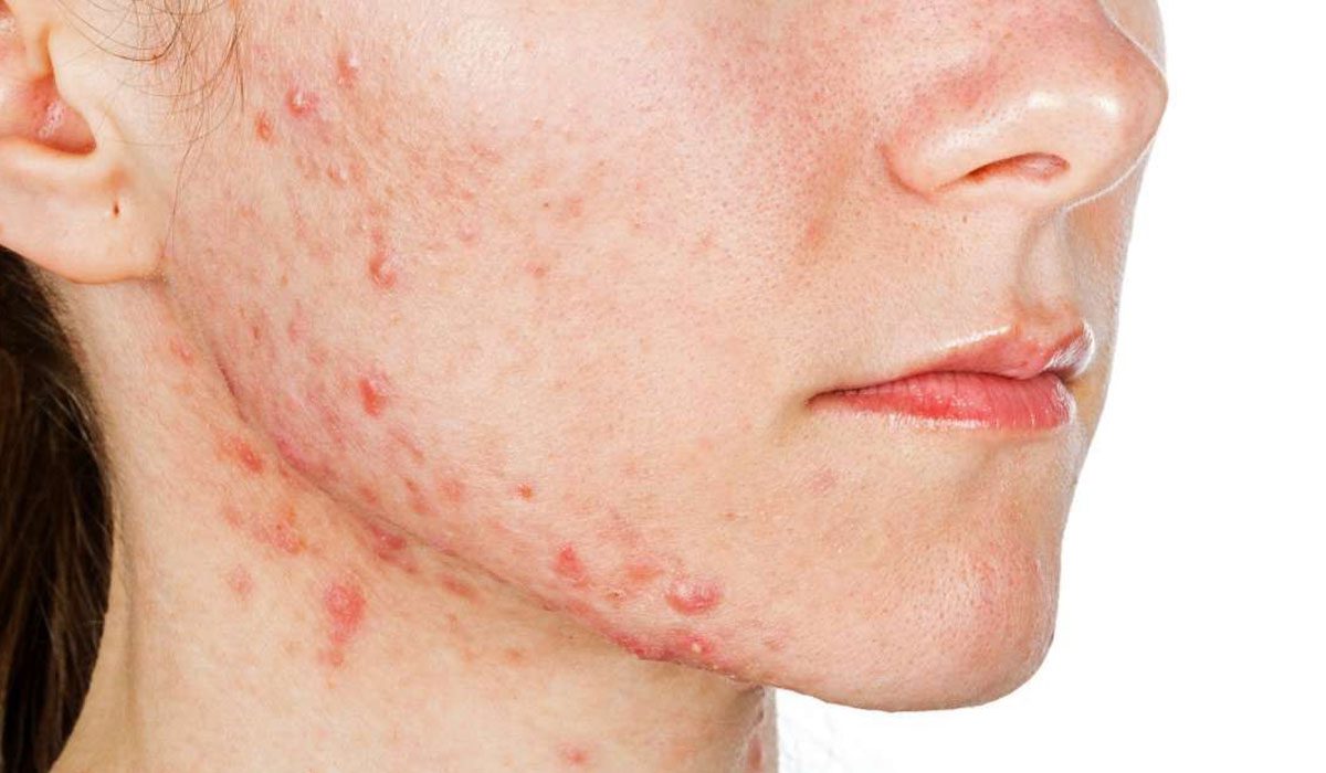 درمان آکنه شدید