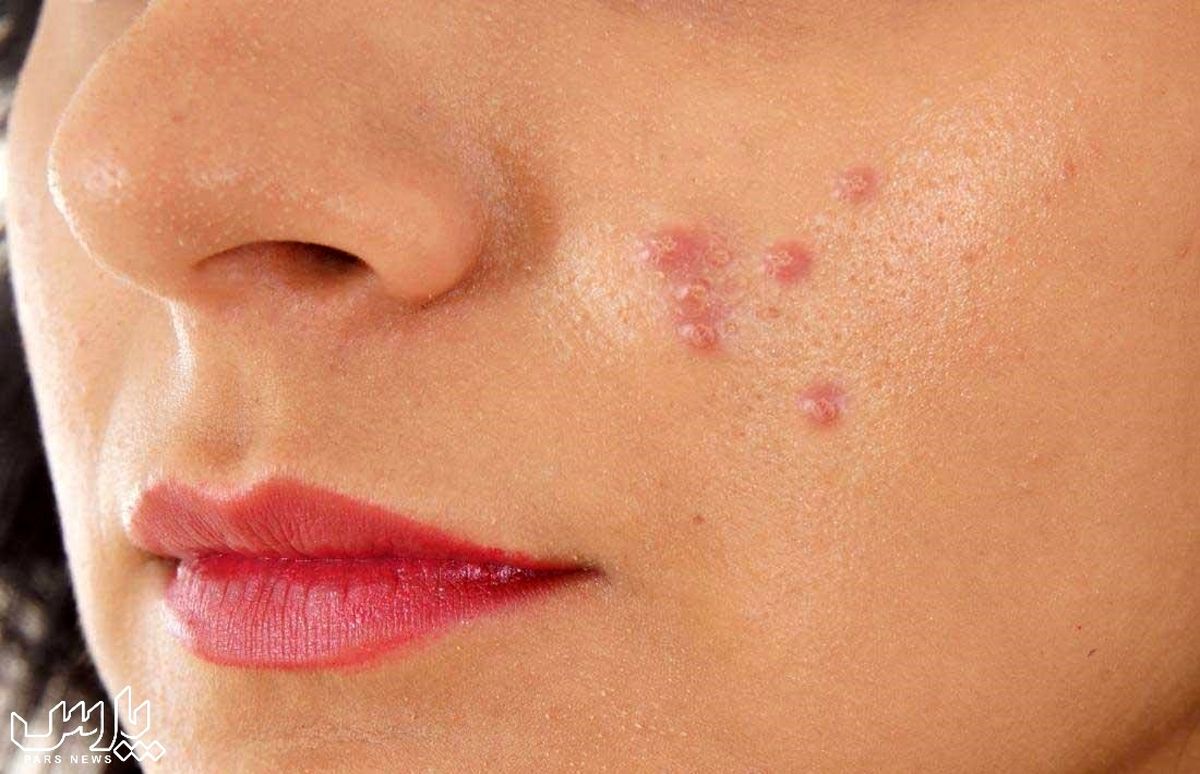 درمان جوشهای زیرپوستی