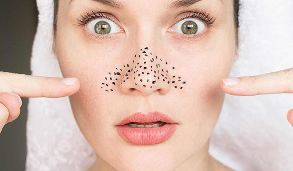 راهکار درمان جوش سر سیاه