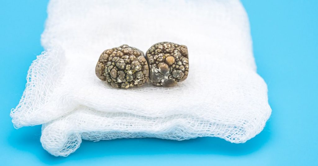 سنگ کیسه صفرا