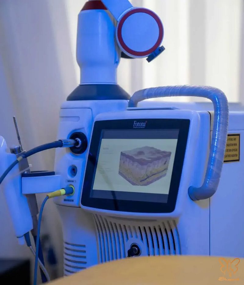 لیزر فوتونا
