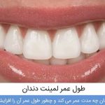 لمینت دندان چقدر دوام دارد؟ نکات طلایی برای افزایش ماندگاری