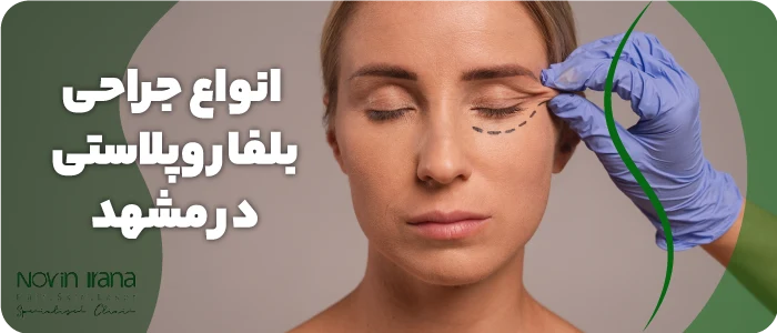 بلفاروپلاستی