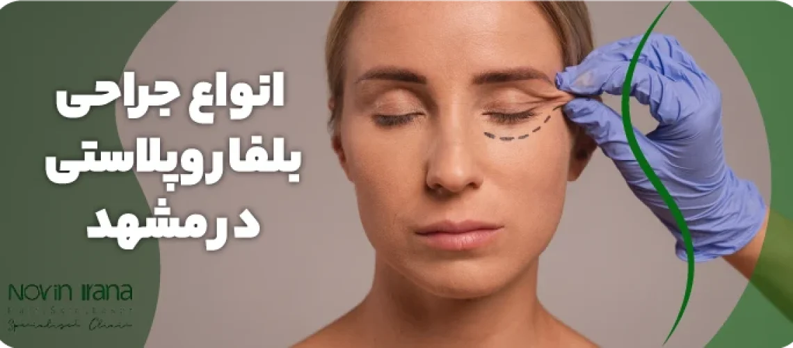 بلفاروپلاستی