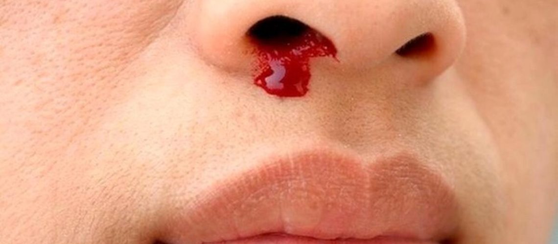 پیشگیری از خون دماغ